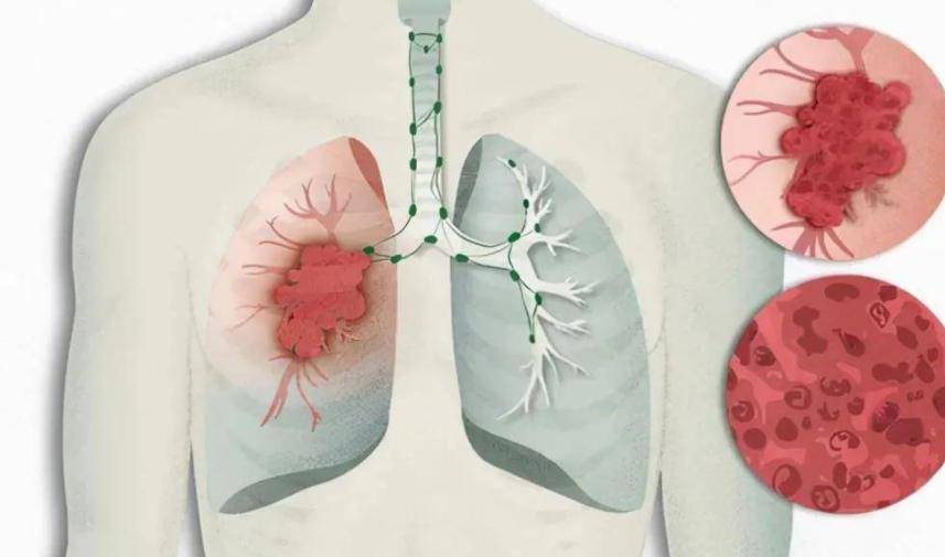 肺腺癌患者走到最后是啥样？多位医生叹息：这几种表现太典型