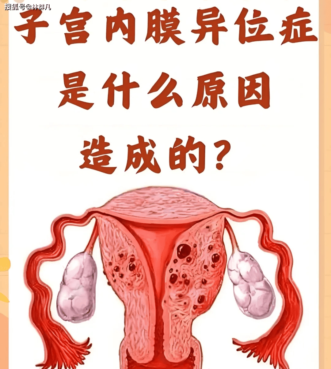 林群凡主任分享：女性子宫内膜异位症是如何形成的？具体有哪些表现？