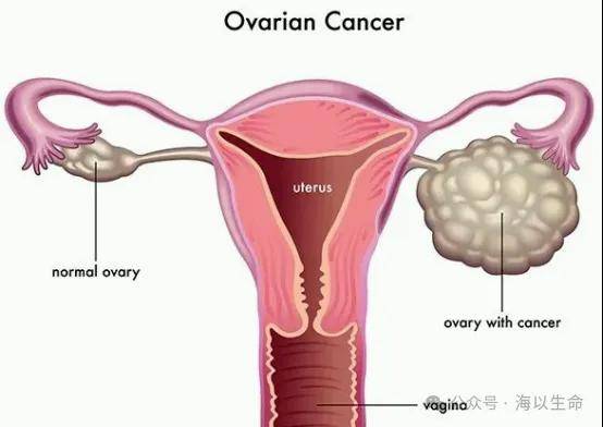 全球首款靶向CDH6的ADC新药获“突破性疗法”认定，包括卵巢癌在内的多类癌症患者将受益！