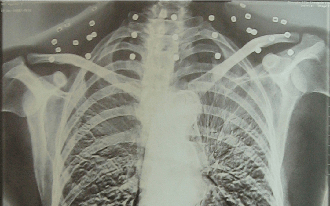 “老先生，您把项链取下来再做CT”“你看是不是弹片”