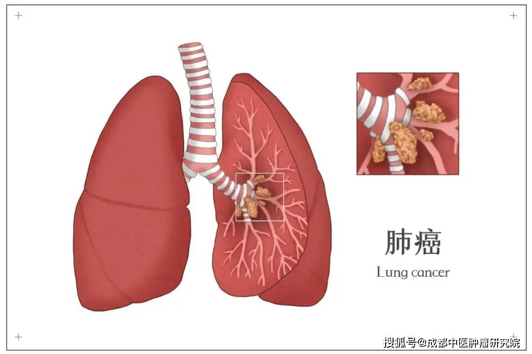 身体出现这些信号，别总当小事！成都陈中刚提醒：7个症状不止咳嗽，可能是肺癌中晚期
