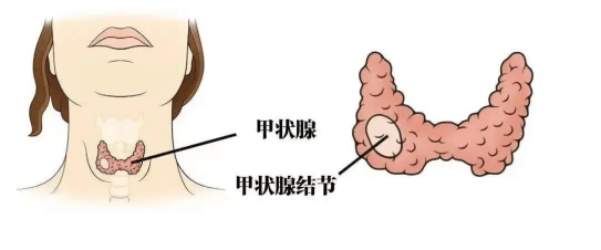 有甲状腺结节？这4种食物要少吃！西安甲康医生总结的“忌口清单”，收好