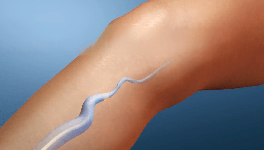 中后期下肢静脉曲张如何治疗？