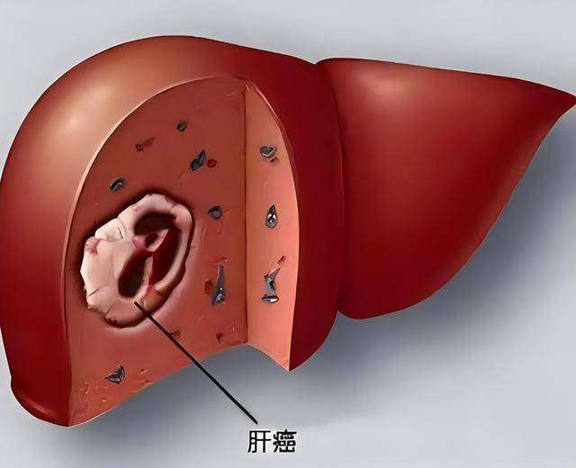 原创            “肝癌手术很成功,病人却活不长?”医生:很多人术后忽视这3事