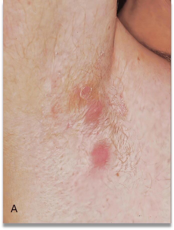 化脓性汗腺炎早期长啥样？一张图帮你辨认