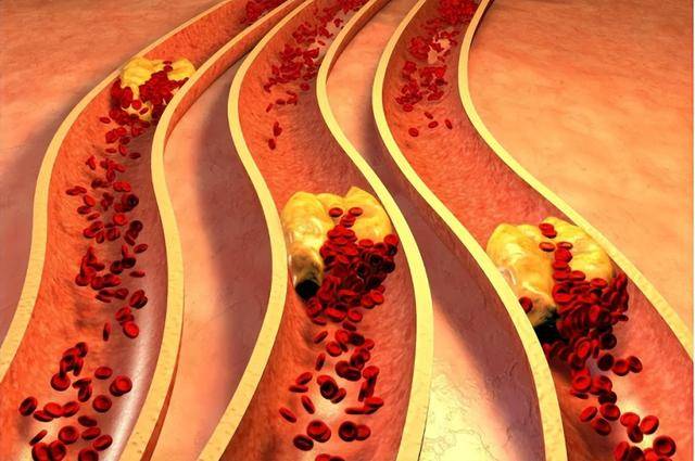 原创            马上停止5类运动，很可能加速血栓形成！等血管“堵死”就迟了