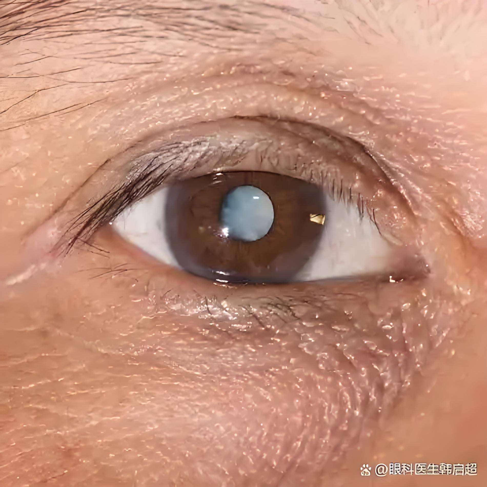 白内障初期症状，都有哪些预防与治疗方法？