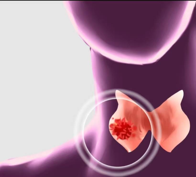 甲状腺癌是 “懒癌” 吗？治愈率真的很高吗？