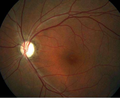 眼睛也会缺血？警惕视神经病变！