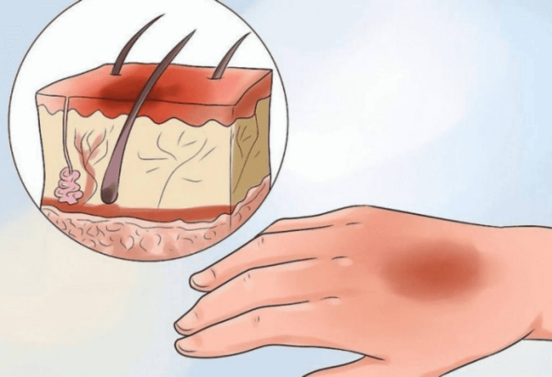 为何你的伤口爱“留印”？探究疤痕体质的秘密