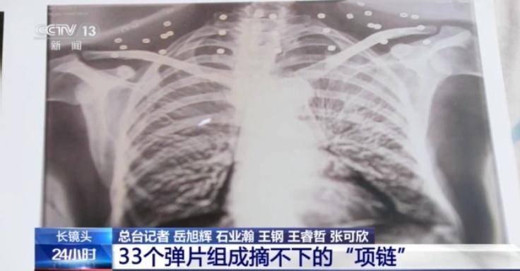 33个弹片成了老兵摘不掉的“项链”