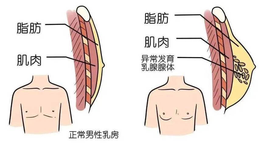 男性乳腺发育：很多都与肥胖“脱不了干系”