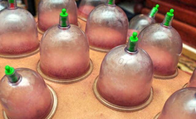 拔火罐吸出来的瘀血，是体内的毒素？将大实话告诉你，看完涨知识