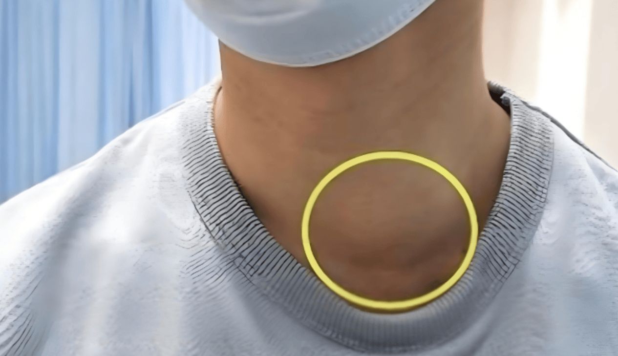 关于甲状腺结节的3个误区，别再信了！科学应对，避免过度治疗
