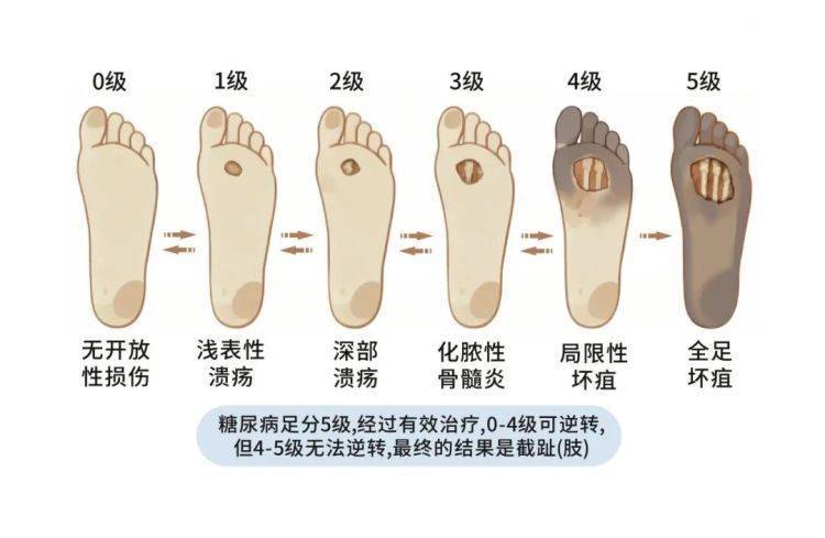 男子患糖尿病剪指甲不小心剪破拇趾，不到两年竟切除十根脚趾！医生提醒