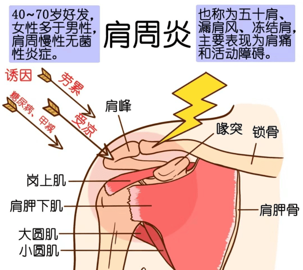 警惕！肩痛夜不能寐、穿衣都费劲？这是肩周炎在 “报警”，教你科学应对不遭罪