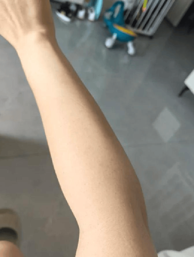 顽固牛皮癣久治不愈？康复妙招揭秘！分享好转心得