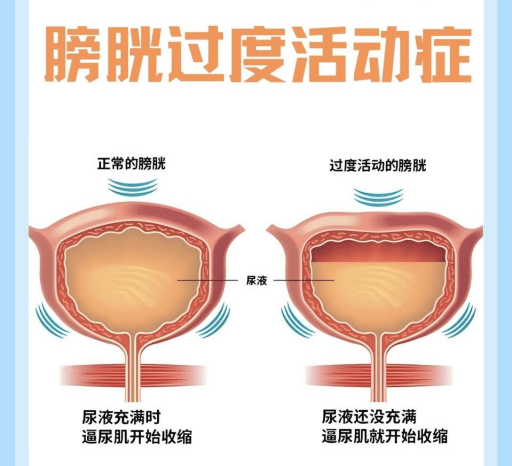 【科普】关注膀胱健康