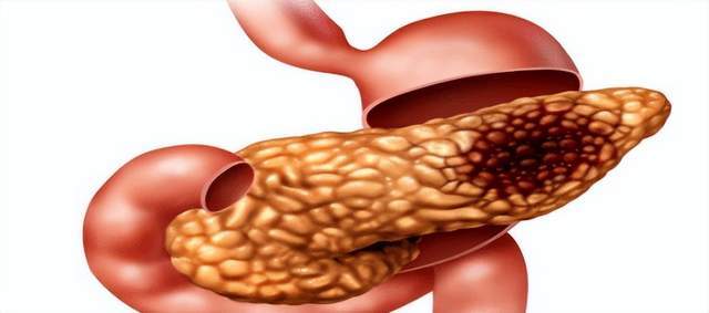 原创            胰腺病变，腹部先知？当你出现这些症状，要小心癌变的可能