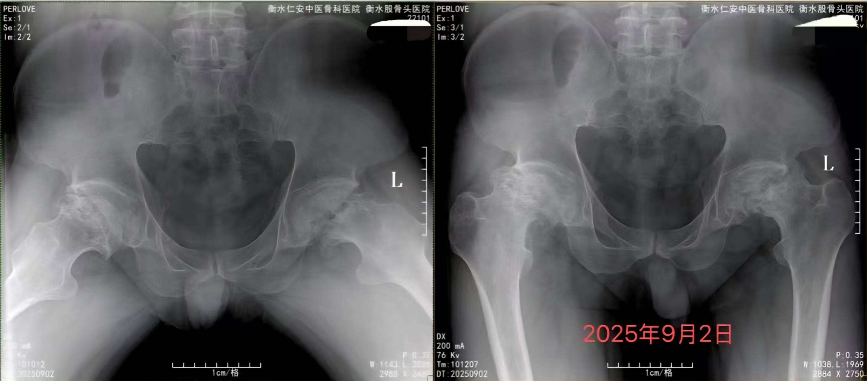 为什么你的腿越来越不听使唤?元凶是股骨头