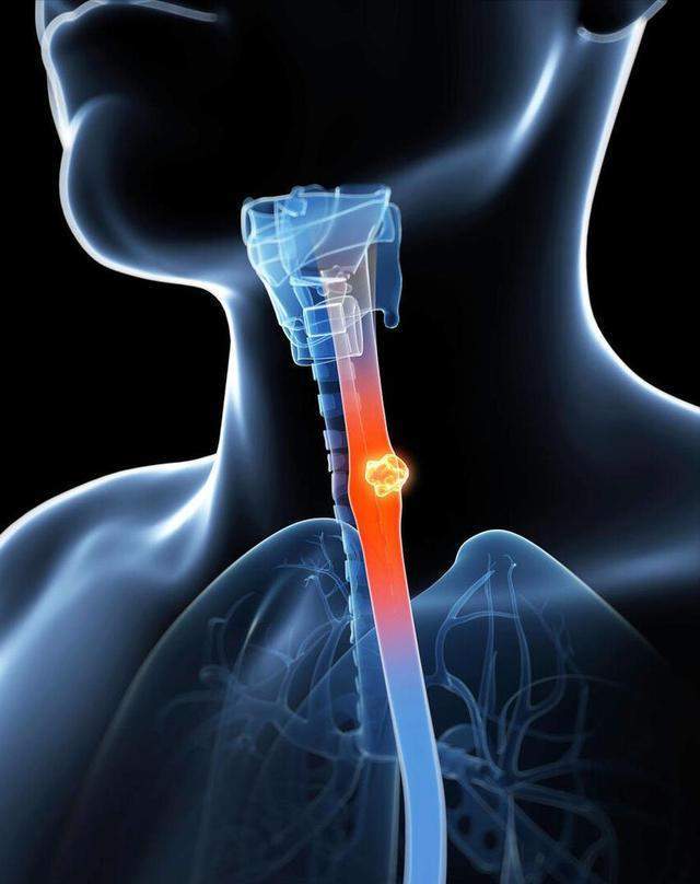 原创            长期饮用超65℃饮品，食管癌风险增加3倍，出现5类症状，别忽视！