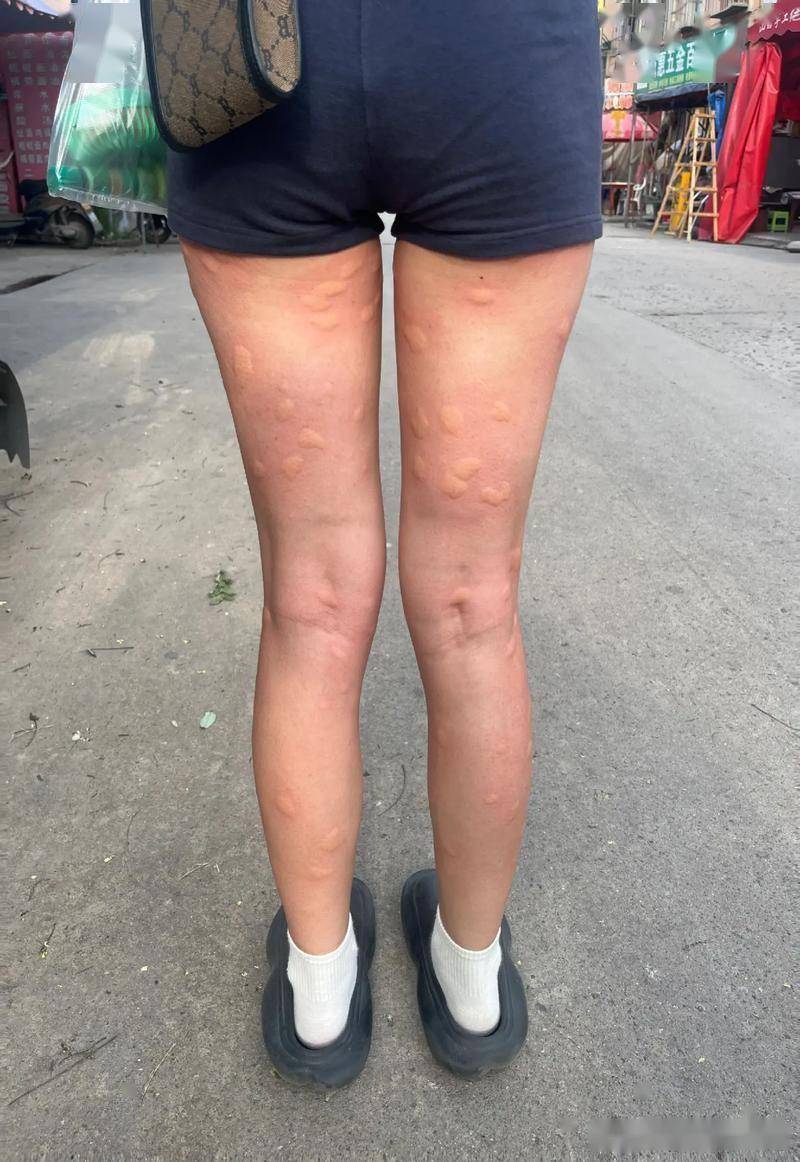 冰岛首次发现蚊子，蚊虫皮肤病，冰岛「无蚊国」神话破灭