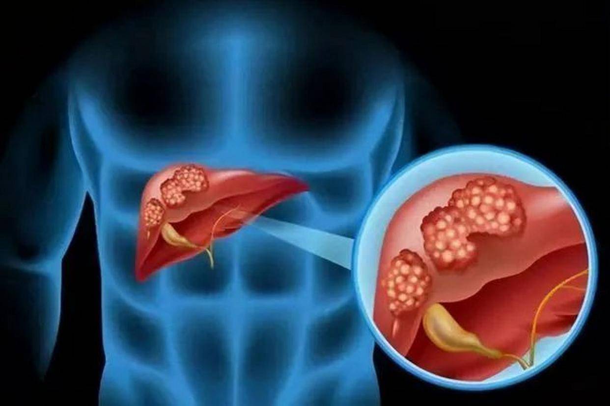 原创            哈佛研究：在肝功能检查中，这4项指标异常，可能是肝癌信号