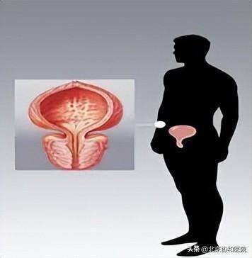 协和医生说 | 关爱男性，守护前列腺健康