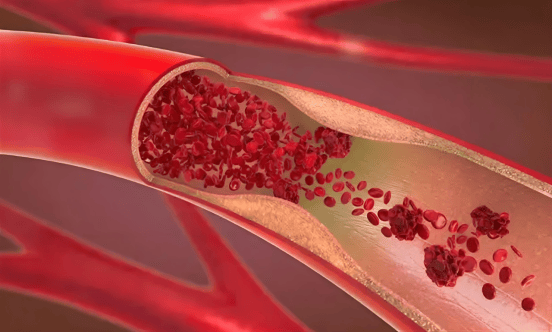 黄力医生：这 5 让血管堵塞的坏习惯你一定要知道