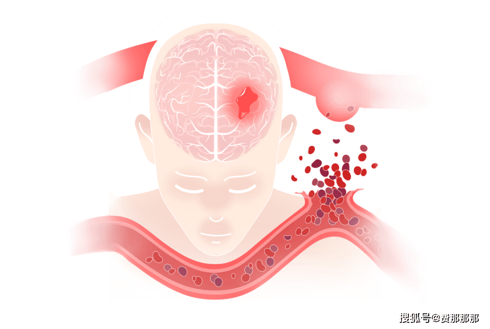 烟雾病不治疗有什么危害？