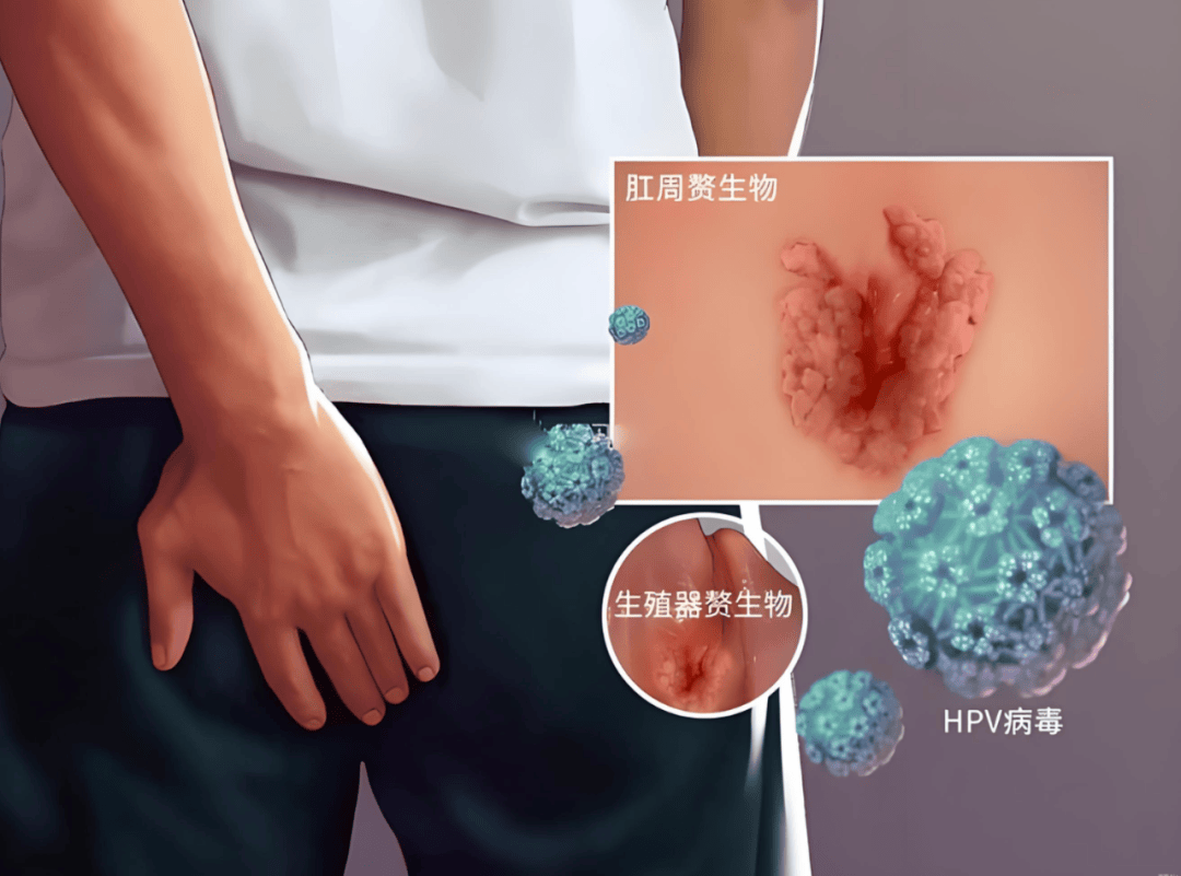 HPV男性感染风险更高!医生示警,恐引发6种癌症