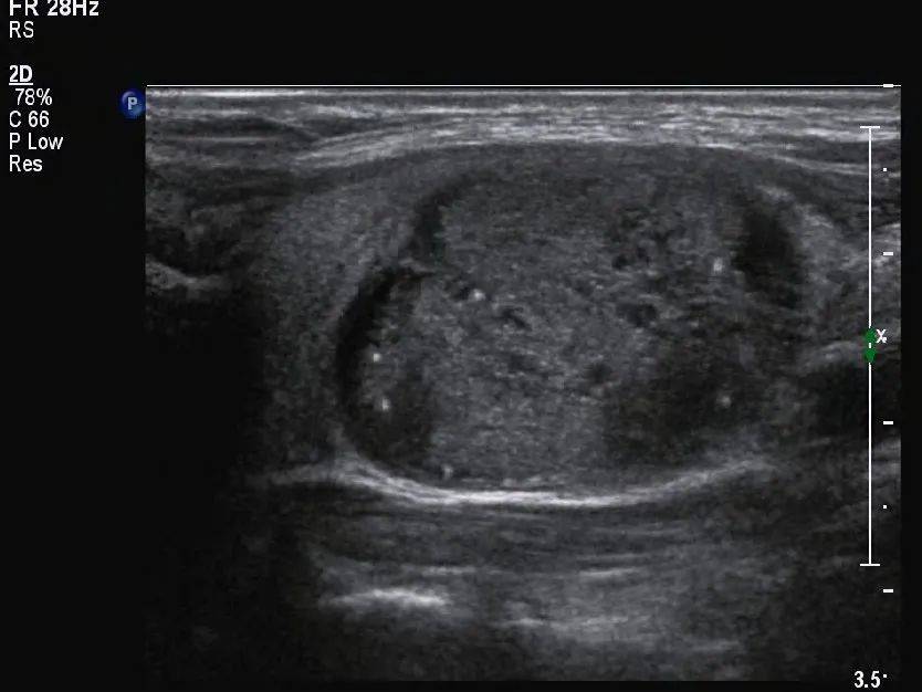 遇到这类甲状腺癌，诊断要小心了！