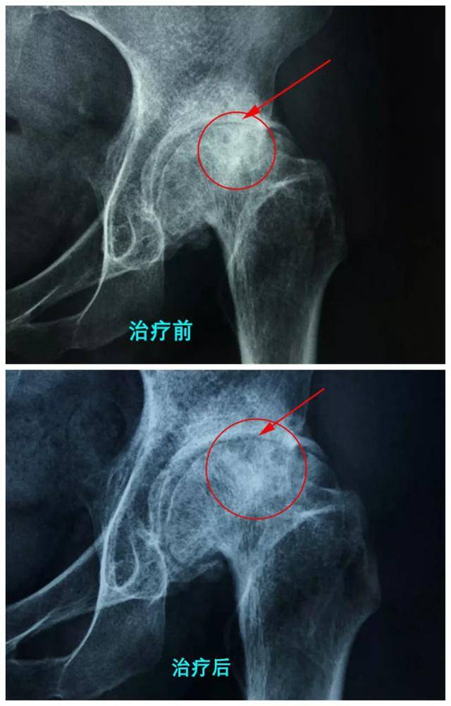 股骨头坏死三期能保守治疗吗？探索新疗法与成功案例