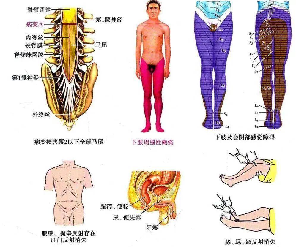 马尾综合征是单独的一个病，还是什么疾病的后遗症呢？