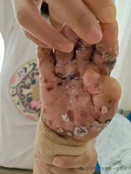 天疱疮新希望：健脾祛湿方剂＋藏药一方有效改善