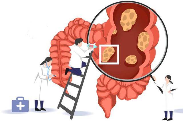 原创            80%肠癌,一发现就是中期?饭后5个表现或是前兆,别以为是小毛病