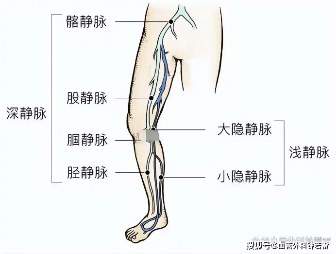 处理病变大隐静脉会影响血液循环吗？医生给出真实答案