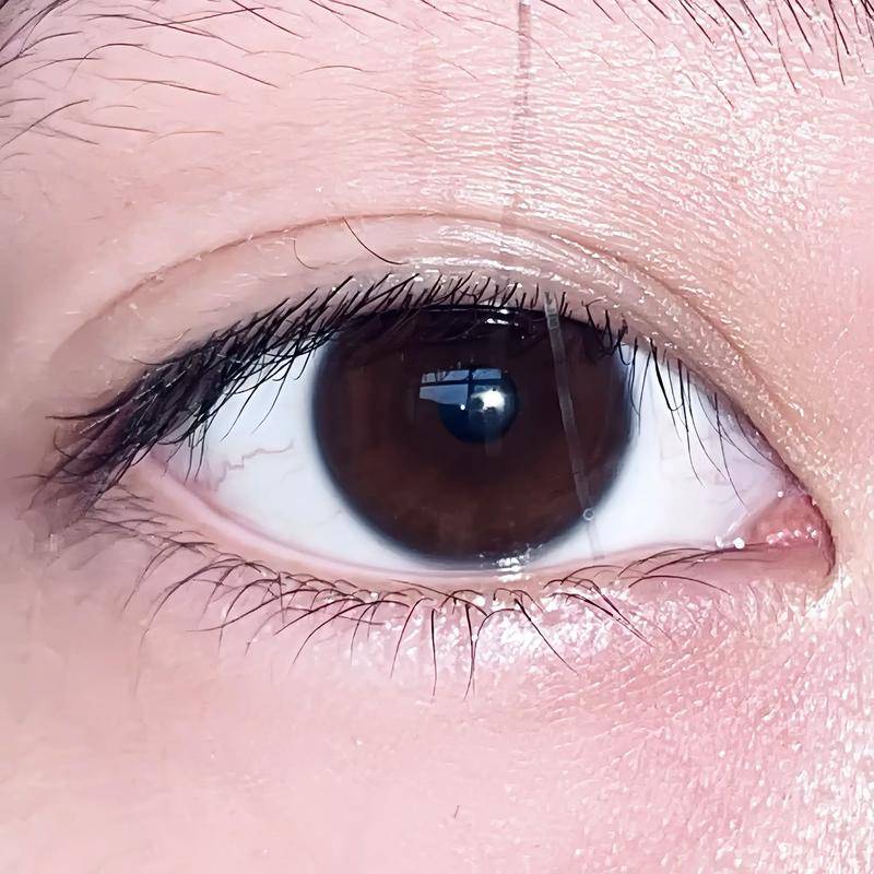 别让 “瘀血阻目” 伤视力！中医拆解视网膜静脉阻塞的应对思路