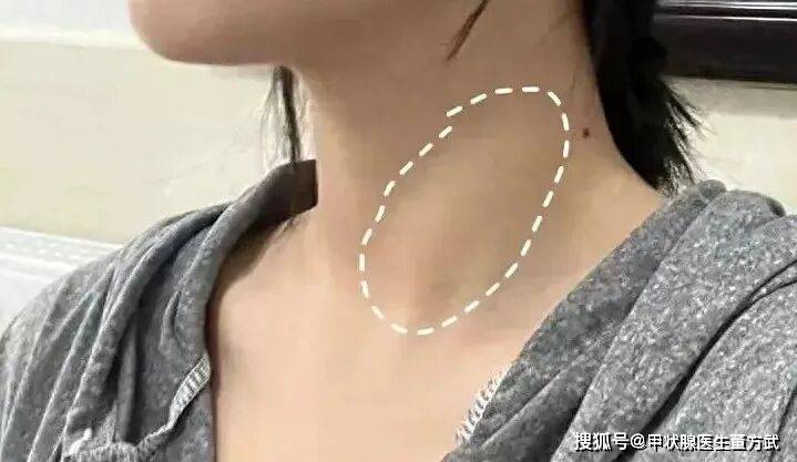 桥本患者必看：不止甲状腺受损，这 8 大并发症更需警惕！