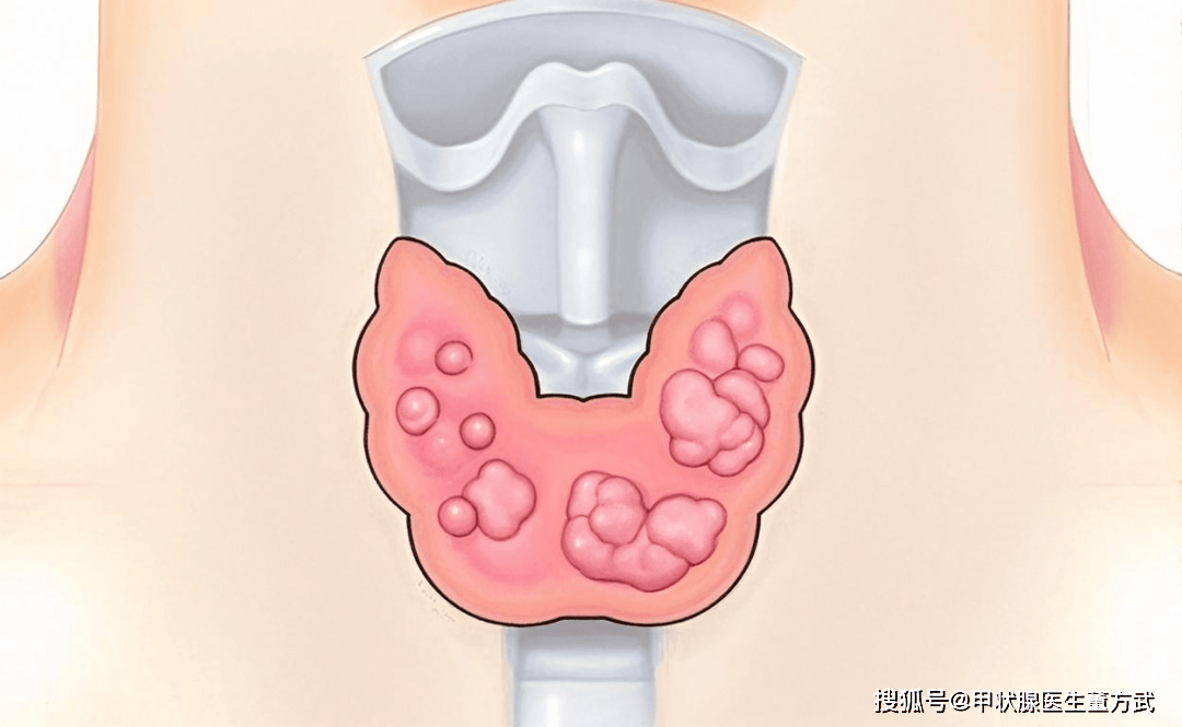 甲状腺结节4A类，不等于癌症，九成不用切！