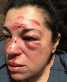 美国一女子散步时因路不平被绊倒脑损伤，市政府愿赔750万美元