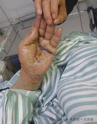 十日清肤：古方融汇祛湿毒，天疱疮调养见奇效