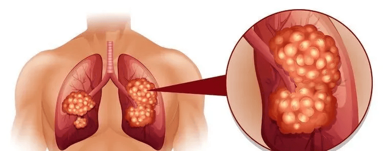 肺癌一查就是晚期？其实双腿早早给了暗示，只是很多人错过了
