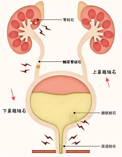 泌尿结石为何“偏爱”男性？这些性别差异藏着答案