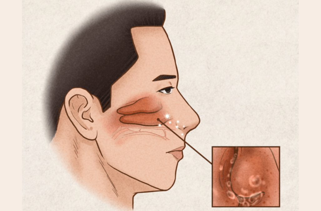 过敏性鼻炎反复发作？调脏腑强体质，守好“呼吸门户”
