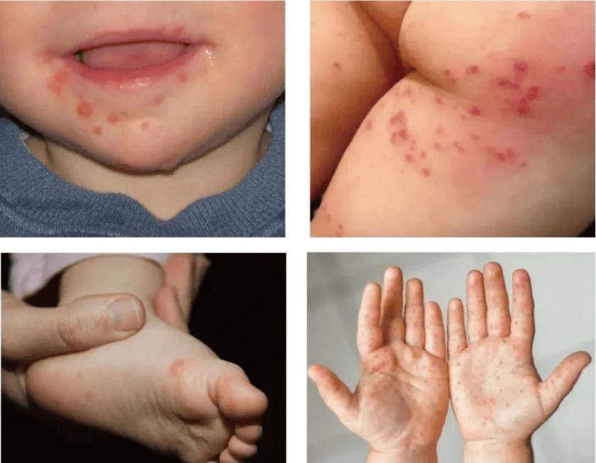 进入高发期！手足口病与疱疹性咽峡炎怎么防？