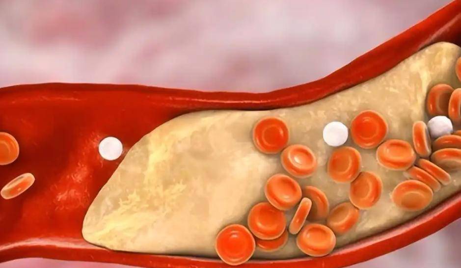 原创            上海瑞金研究：低密度胆固醇越低，癌症风险越高？控制到多少才好