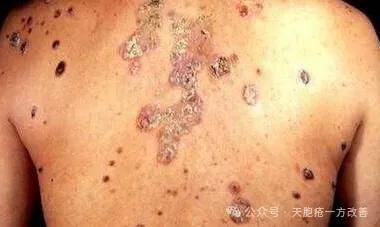 健脾祛湿方＋藏药见真章 天疱疮十日显转机