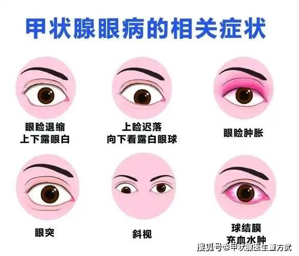 眼睛出现这些“异常信号”，当心甲状腺疾病拉响警报！