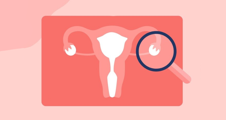 输卵管通而不畅，对生育有三大影响